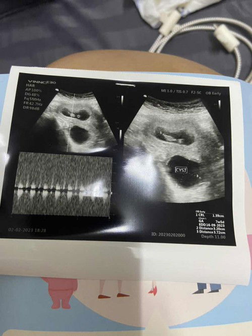 อัลตราซาวด์เจอซีสต์ ระหว่างตั้งครรภ์