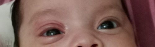 KELOPAK MATA MERAH DARI LAHIR