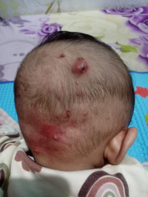 Ada benjolan seperti Bisul