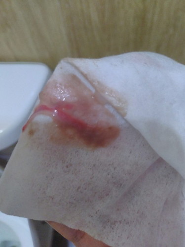 35 weeks discharge