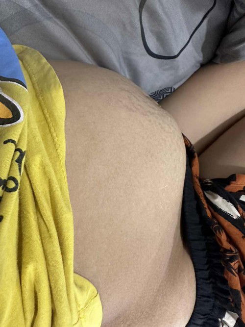 14 วีคแล้วท้องใหญ่ไปมั้ยคะ ท้อง2 คะ น้ำหนักเราลดลงด้วย8 โลแพ้ท้องหนัก คนอื่นท้องใหญ่แบบนี้มั้ยคะ