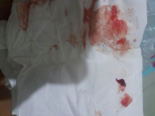 Keluar flek saat hamil 5 minggu