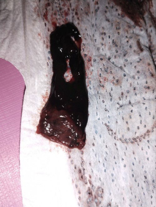 แท้งไหมคะท้องแรกคะ