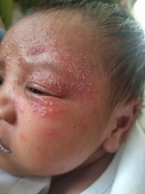 Rashes sa Face