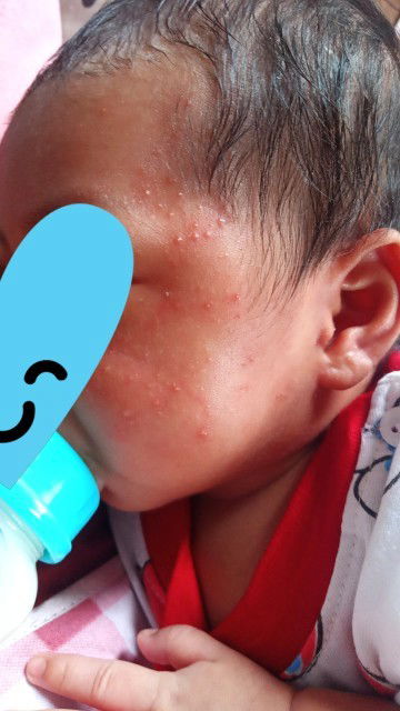 Bintik merah pada bayi