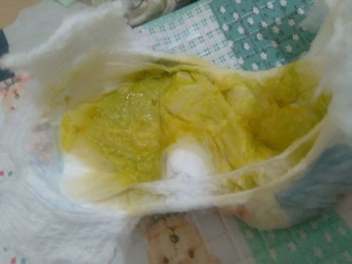Bab Bayi 4 bulan 11 hari warna hijau begini bun apakah normal? Biasanya warna kuning kecoklatan.