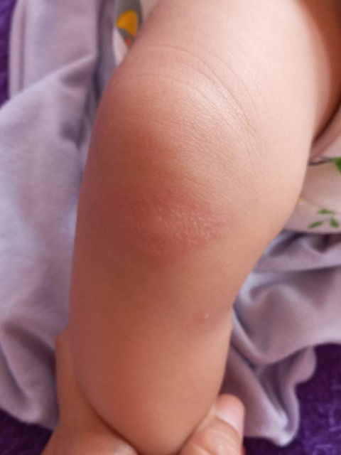 Ruam menjadi bentol di kulit kaki