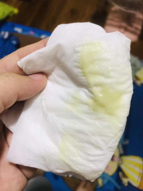 ตกขาวสีแบบนี้ปกติไม