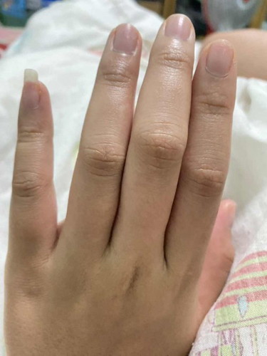 31 Week มือบวมหน้าบวม