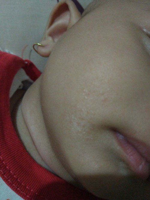 Bruntusan 1 bulan belum hilang