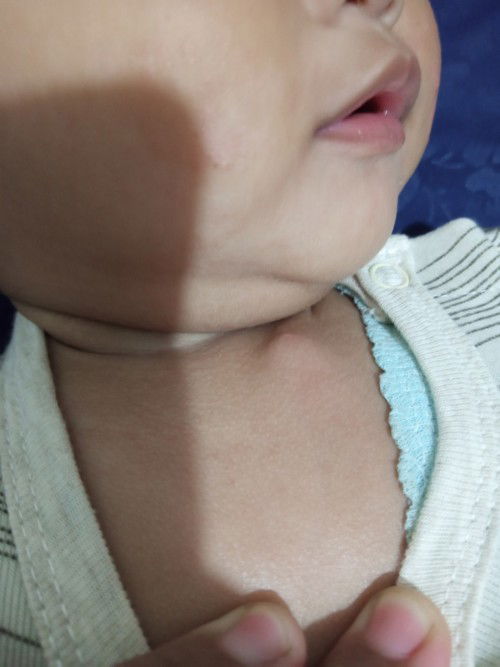 Benjolan di bawah leher