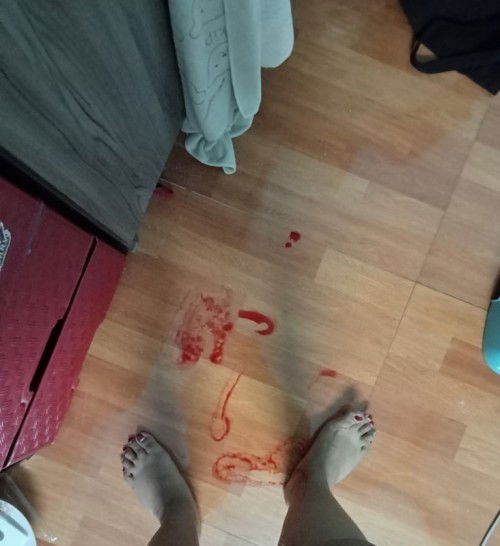 ติ่งเนื้อปากมดลูก