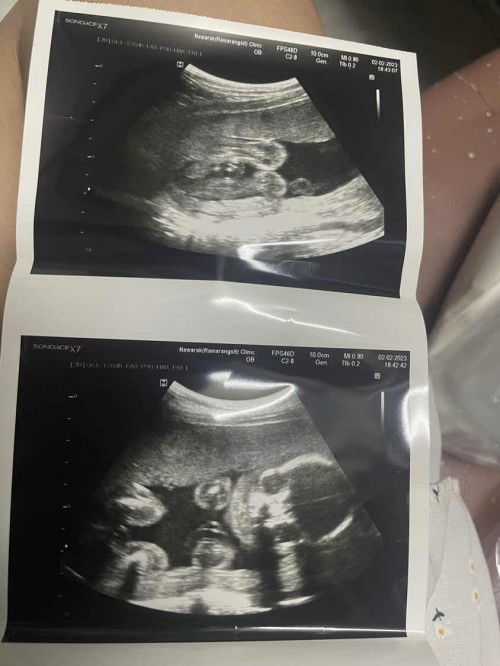 21w6d น้ำหนัก439g น้อยไปหร่อป่าวค่ะ