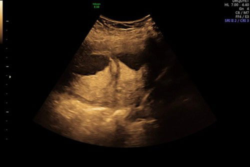 Vách ngăn tử cung 1 phần khi mang thai 20w