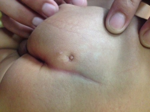 รูตรงก้นลูก