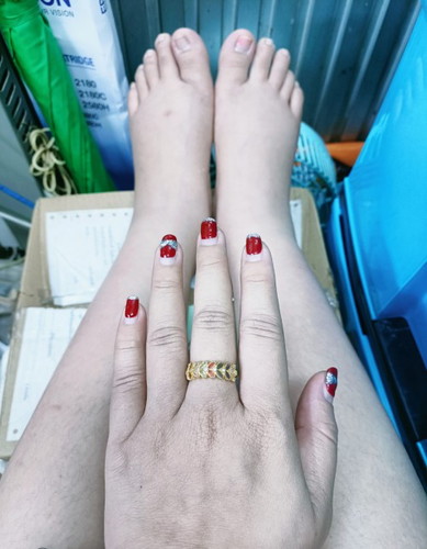 มือเท้าบวม