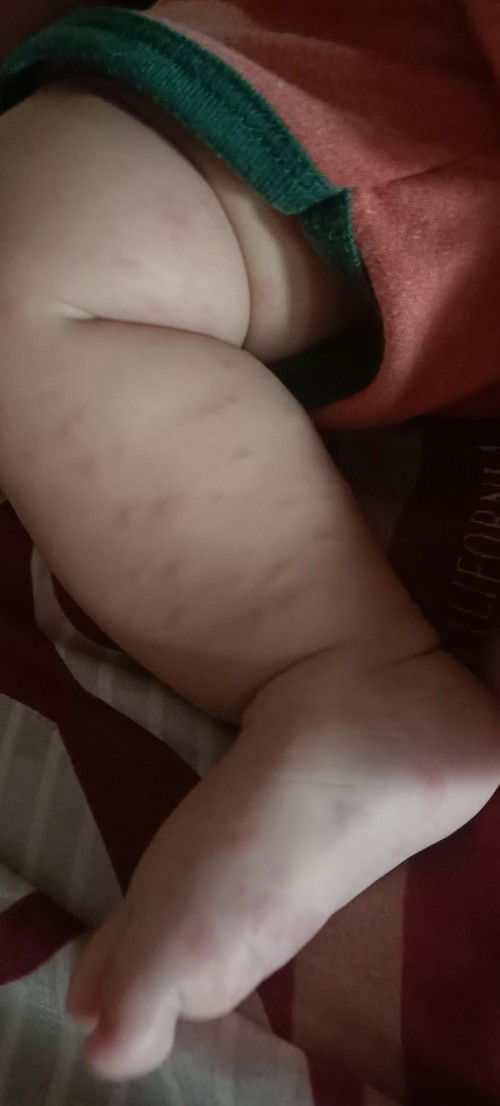 Kalo alergi oleh vaksin pcv gak ya ?