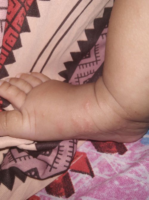 Gatal bintik berair di telapak kaki