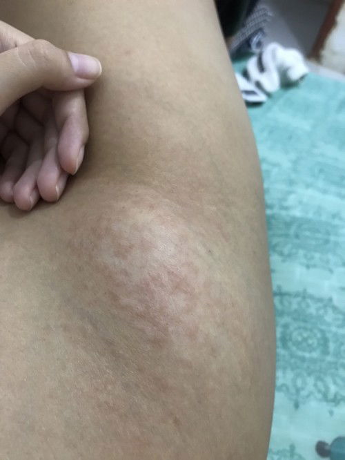 Biduran/biang keringat bumil 7weeks?