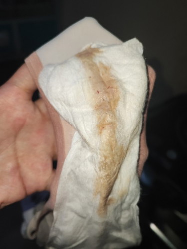 dugo sa napkin @ 39wks 1cm