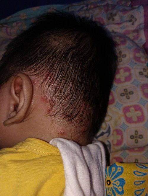 boils po ba o folliculitis to?