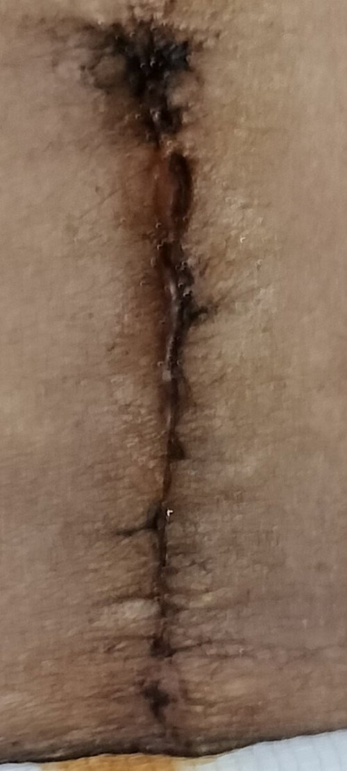Cesarean bumuka po ba