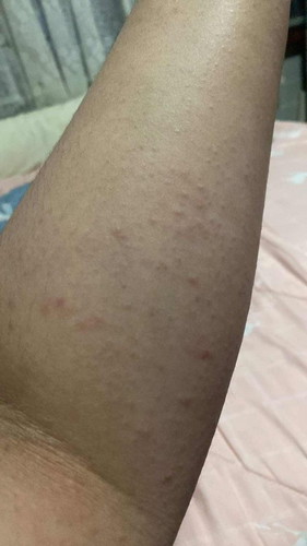 เป็นผื่นที่แขนและขา