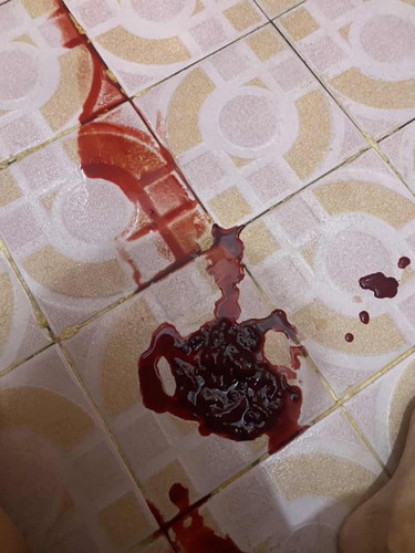 Blood clot after 2 weeks of Miscarriage