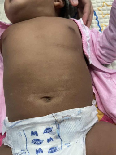 Kulit baby mengelupas kasar