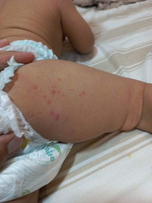 Diaper Rash?