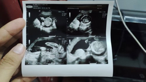 Smlm baru usg bun,hpl ku juni usia nya bru 21 weeks 6 days,semoga bunda2 dsini dan janin nya sehat2