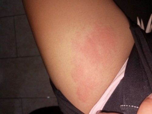 Normal lang ba mga momsh na magkaroon ng skin rash both legs ko po kasi tapos ang itchy at mahapdi?