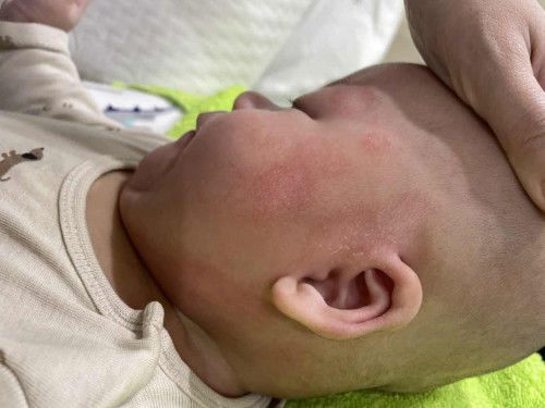 Ringworm in babies