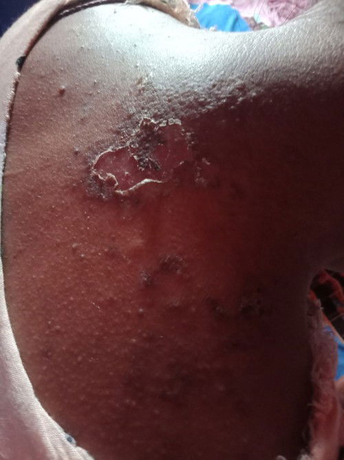 Liat badan penuh koreng