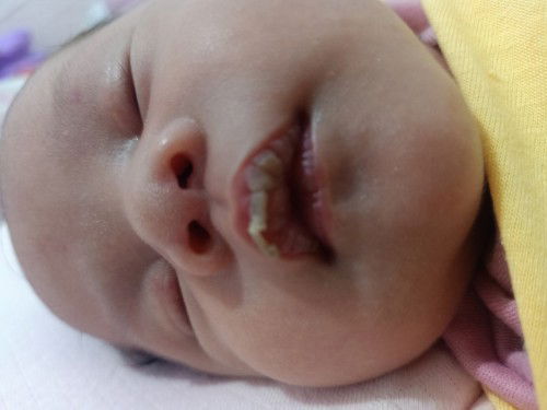 Apakah bibir pecah pada bayi aman?