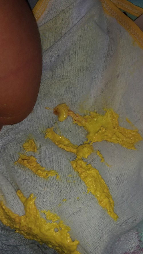 Disentri bayi umur 26hr