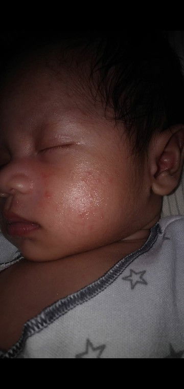 Bun ada yang tau kenapa ya pipi anak saya bintik-bintik merah