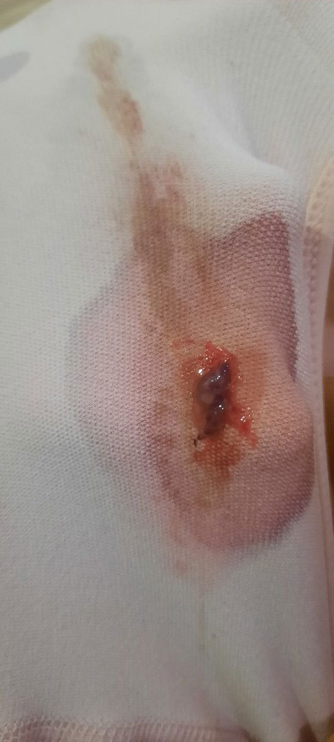 Bun mau tanya.. saya OP kuret hari sabtu kemarin (4/2/23).. setelah OP keluar darah lumayan banyak..