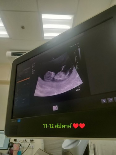 เอารูปมาฝากแม่ๆ ดูน้องวันนี้ 11 w 5 d