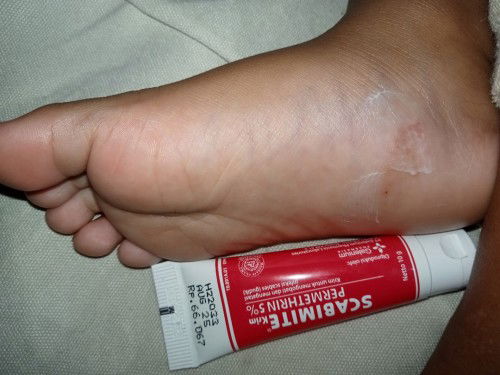 Bun..anak saya akhir2 ini ada masalah kulit.Yg saya bingung kutu air, gimana cara ngobatinya ya bun?