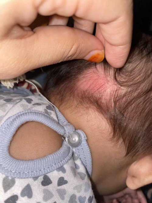 Belakang kepala baby 3 bulan ruam. Normal ke? Punca sebab apa ya?