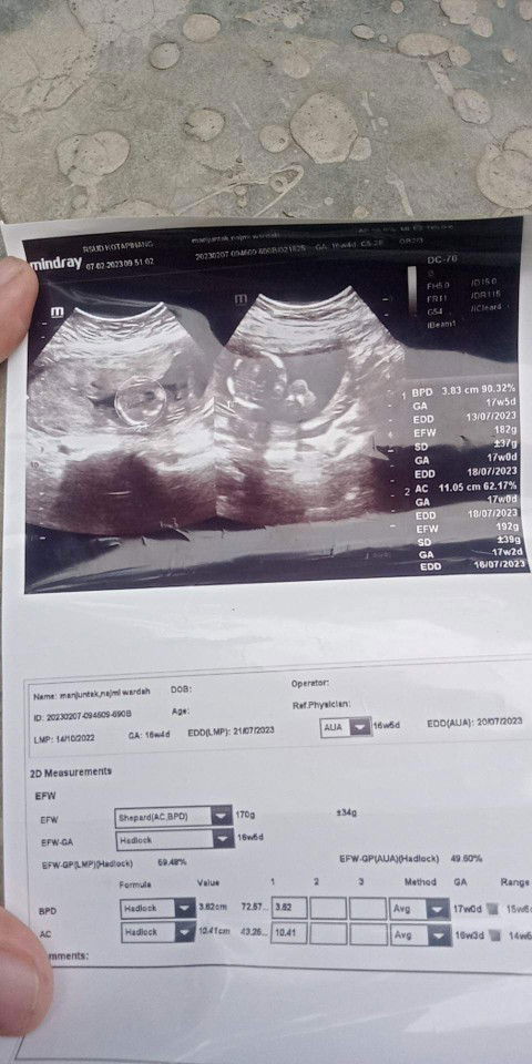 Kata dr kemungkinan hamil kembar