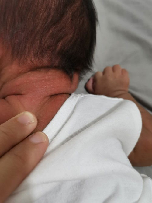 Rashes one month old si baby