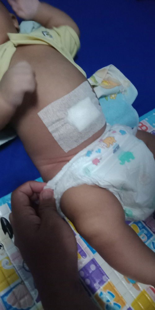 Bayiku usia 1 bulan 21 hari telah menjalani operasi hernia umbilikal, adakah mom's yang pernah juga?