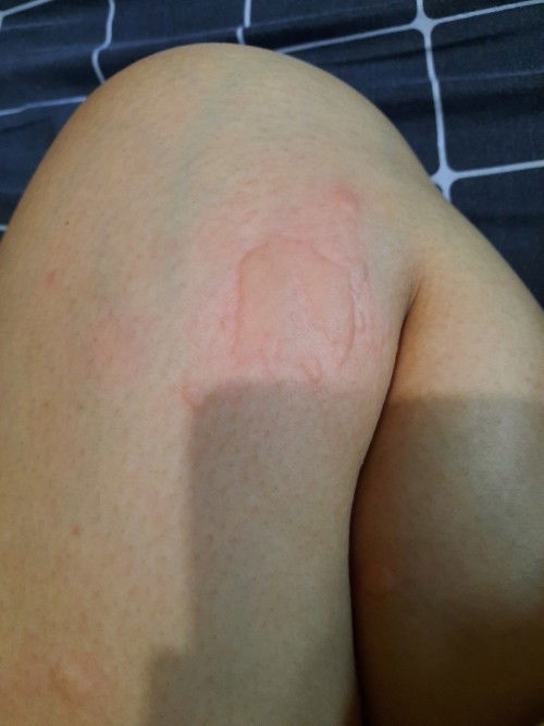 Biduran pada ibu menyusui