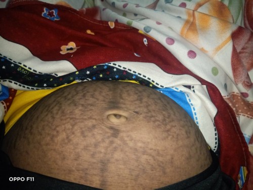 Stretch mark remedy