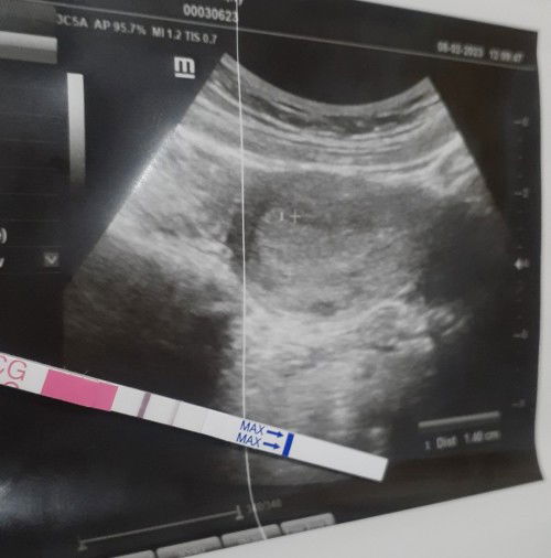 Rekomendasi tempat usg tv moms