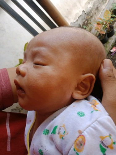 Bercak Putih, Bruntusan Bayi