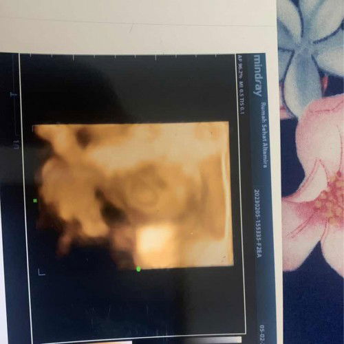 Flek di usia kehamilan trimester 1