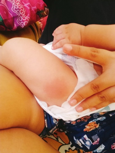 Normal po bang medyo mamaga ang tusok ng bakuna ni baby?